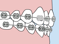 virtual model of braces with a loose bracket
