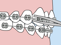 virtual model of braces with a loose wire