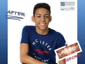 young male patient's smile before and after treatment
