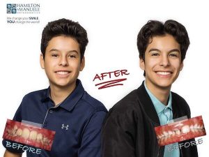 young brothers before and after treatment