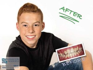 young male patient's smile before and after treatment