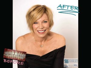 middle-aged female patient before and after treatment