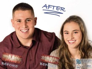 brother and sister before and after treatment