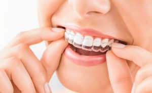 woman putting on a set of invisalign clear aligners