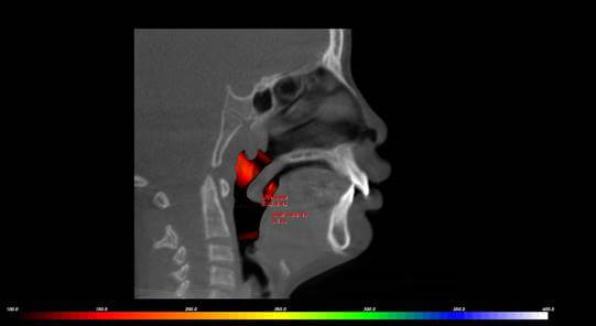 An xray of a child's bad airway