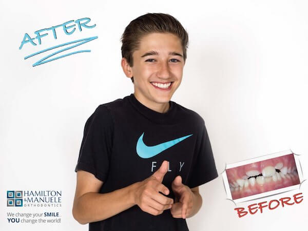 Before and After photo of Hamilton & Manuele patient after metal braces