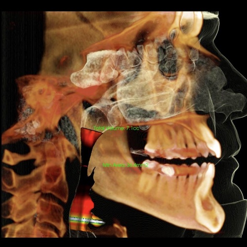 Photo example of a compromised airway