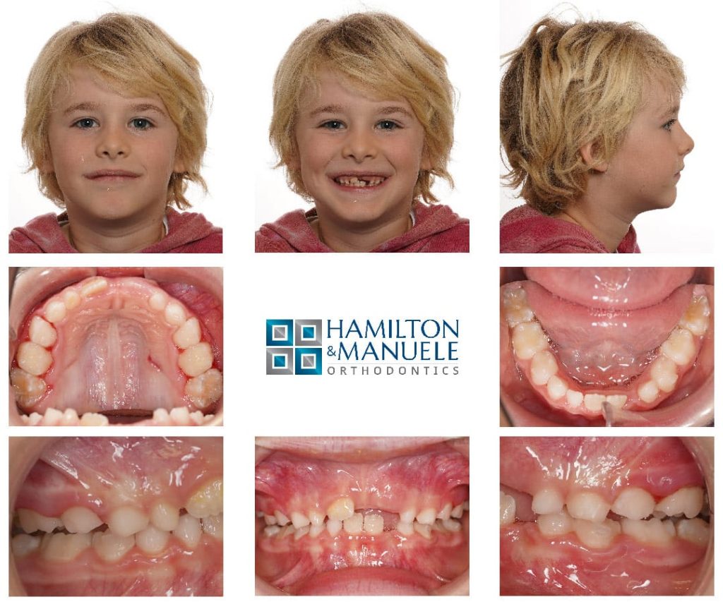 A child airway patient after 4 months of treatment at Hamilton and Manuele