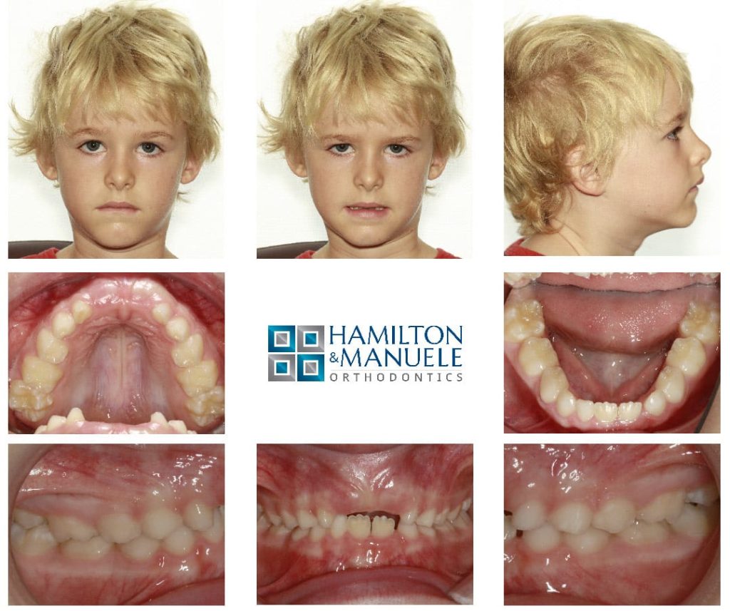 A child airway patient at the start of treatment at Hamilton and Manuele