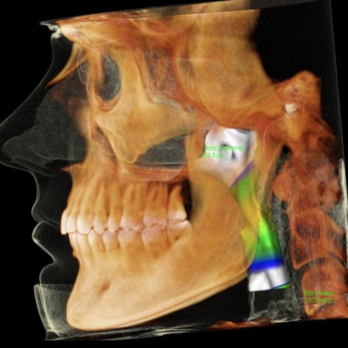 Photo example of a good airway
