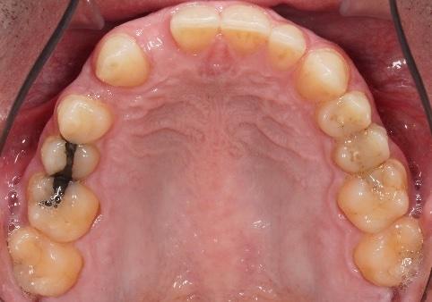 before-bottom
